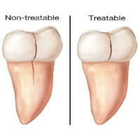 Cracked Teeth