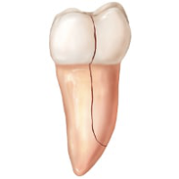 Split tooth