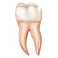 Vertical Root Fracture